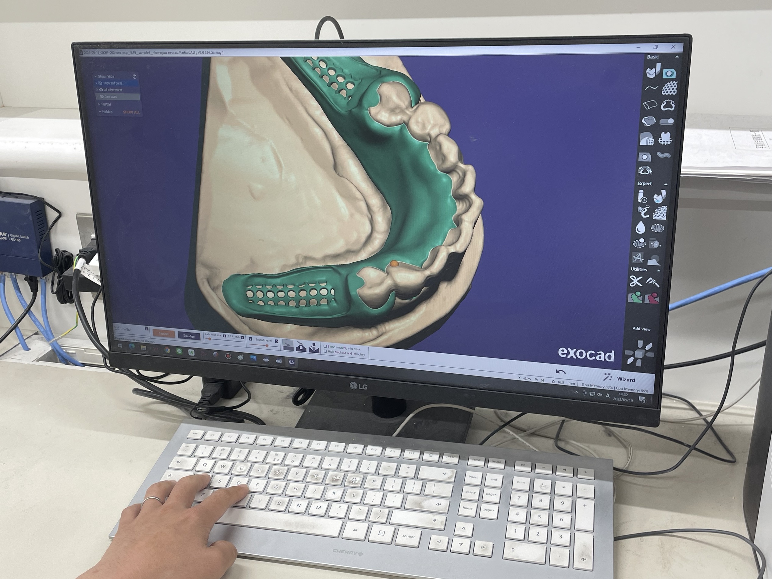 歯の3D画像